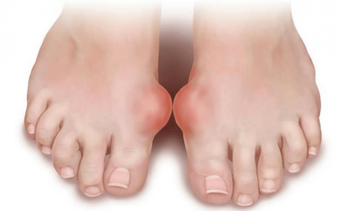 Fußdeformität als Ursache für Pilzbefall an den Beinen