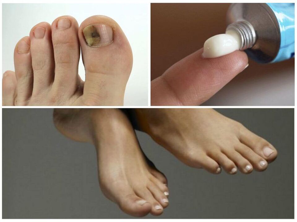 Behandlung mit Salben