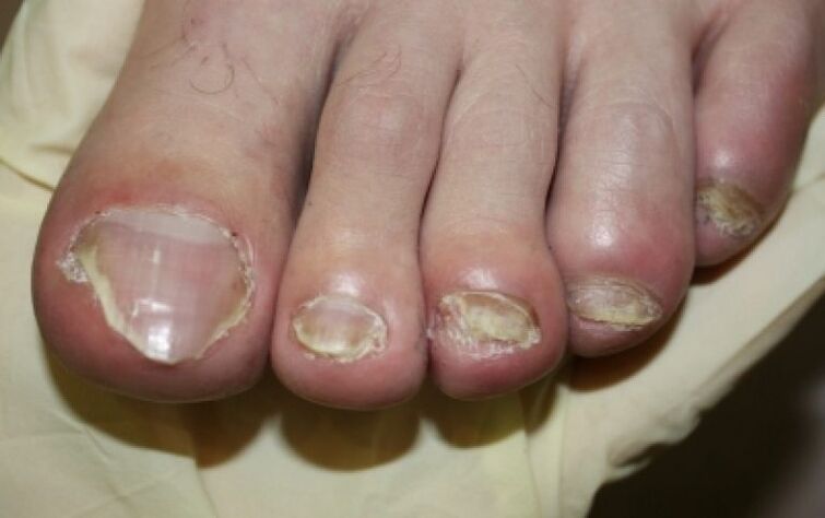 Nagelpilz