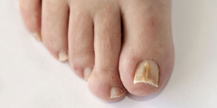 Nagelpilz
