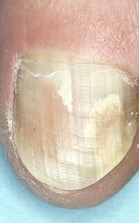 Nagelpilz