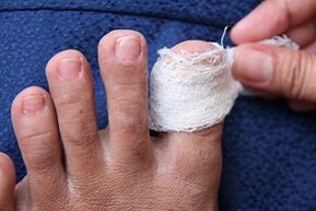 Kompresse gegen Nagelpilz