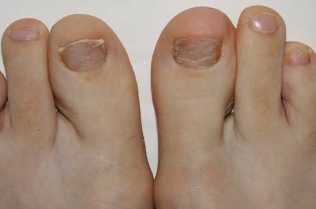 Symptome von Fuß-Pilz